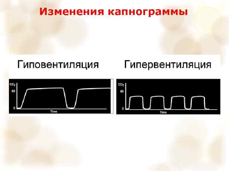 Изменения капнограммы 