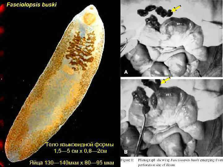 Fasciolopsis buski Тело языковидной формы 1, 5— 5 см х 0, 8— 2 см