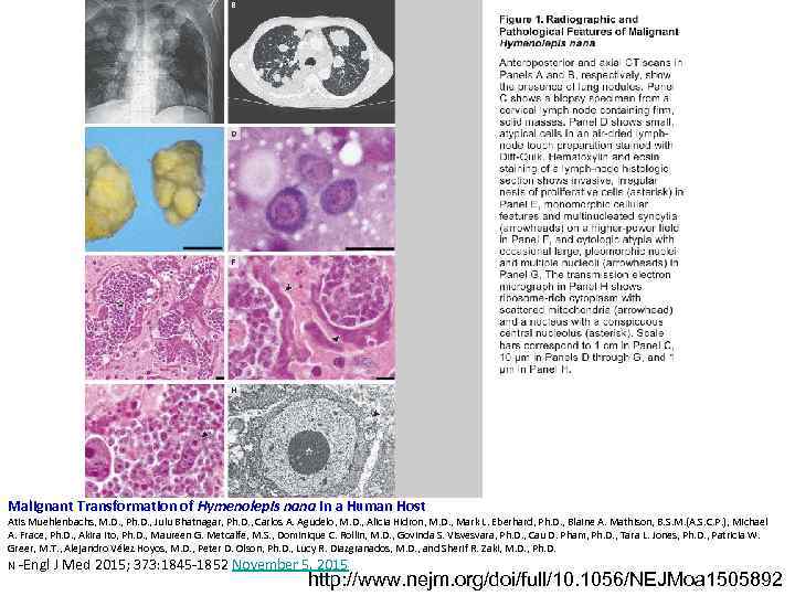 Malignant Transformation of Hymenolepis nana in a Human Host Atis Muehlenbachs, M. D. ,