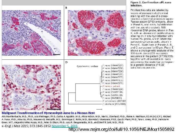 Malignant Transformation of Hymenolepis nana in a Human Host Atis Muehlenbachs, M. D. ,