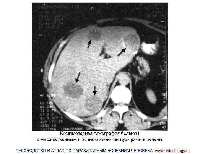 РУКОВОДСТВО И АТЛАС ПО ПАРАЗИТАРНЫМ БОЛЕЗНЯМ ЧЕЛОВЕКА www. infectology. ru 