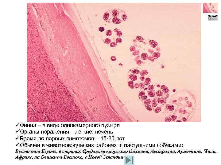 Echinococcus granulosus üФинна – в виде однокамерного пузыря üОрганы поражения – легкие, печень üВремя