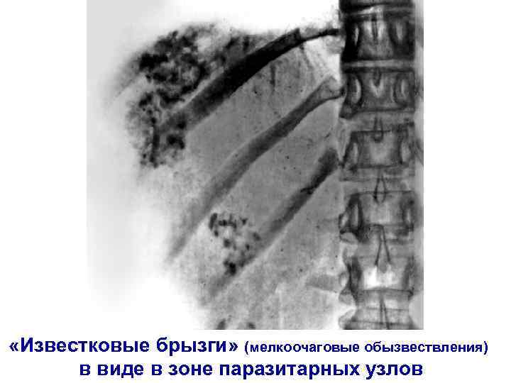  «Известковые брызги» (мелкоочаговые обызвествления) в виде в зоне паразитарных узлов 