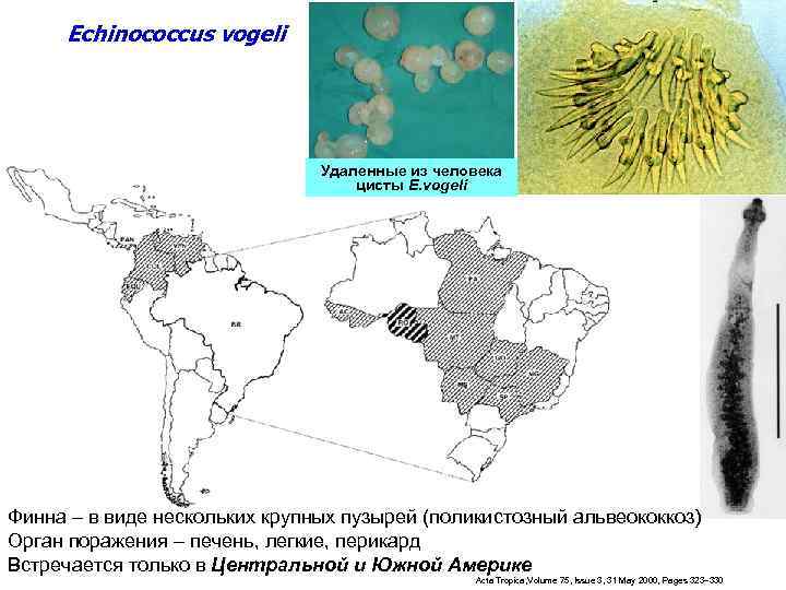 Echinococcus vogeli Удаленные из человека цисты E. vogeli Финна – в виде нескольких крупных