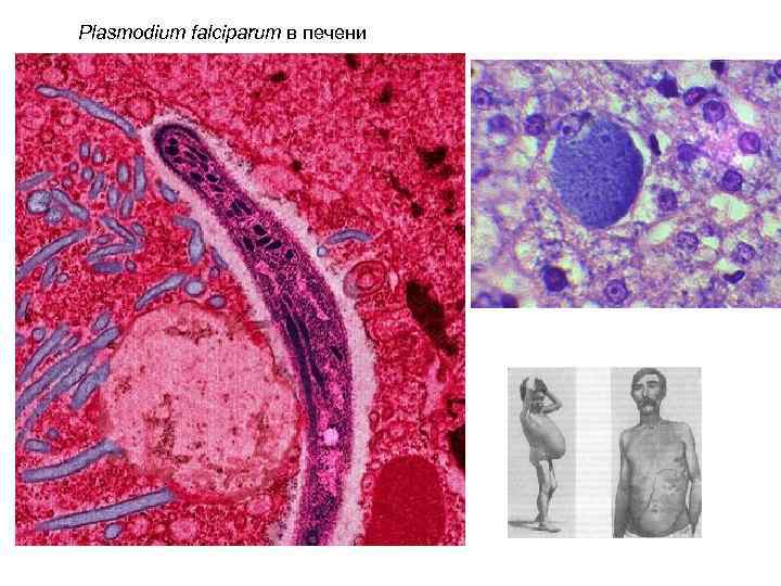 Plasmodium falciparum в печени 