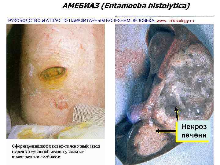 АМЕБИАЗ (Entamoeba histolytica) РУКОВОДСТВО И АТЛАС ПО ПАРАЗИТАРНЫМ БОЛЕЗНЯМ ЧЕЛОВЕКА www. infectology. ru Некроз