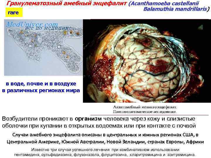 Гранулематозный амебный энцефалит (Acanthamoeba castellanii rare Balamuthia mandrillaris) mandrillaris в воде, почве и в