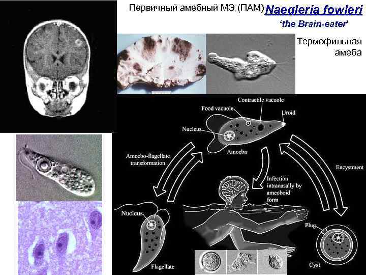 Первичный амебный МЭ (ПАМ) Naegleria fowleri ‘the Brain-eater' Термофильная амеба the Brain-eater' 