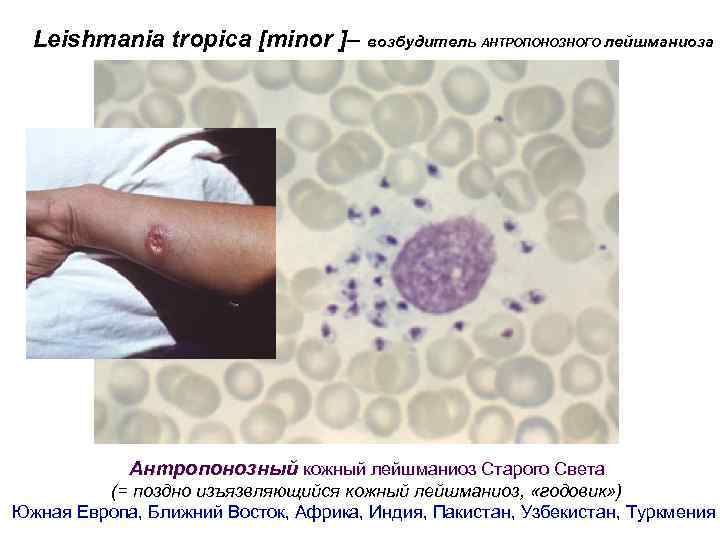 Leishmania tropica [minor ]– возбудитель АНТРОПОНОЗНОГО лейшманиоза Антропонозный кожный лейшманиоз Старого Света (= поздно