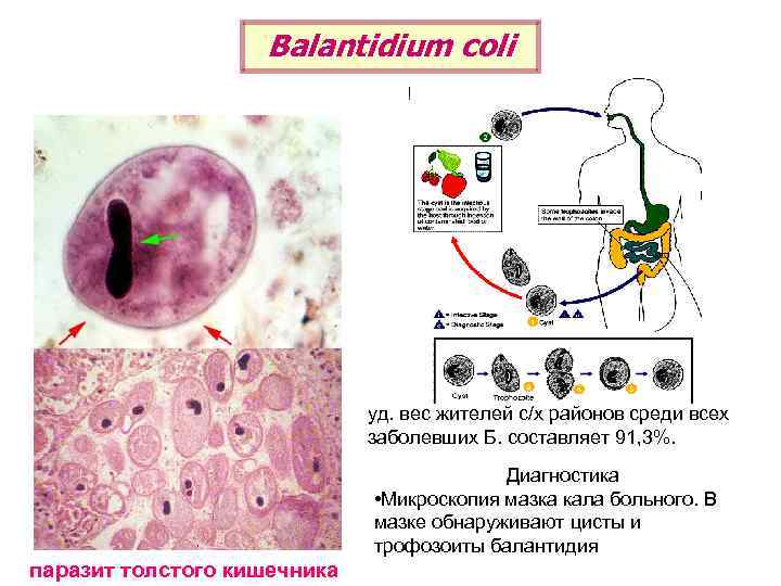 Balantidium coli уд. вес жителей с/х районов среди всех заболевших Б. составляет 91, 3%.