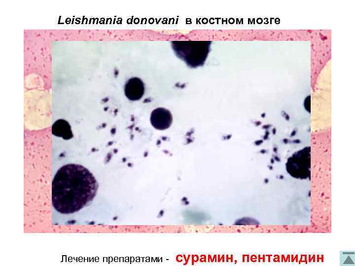 Leishmania donovani в костном мозге Лечение препаратами - сурамин, пентамидин 