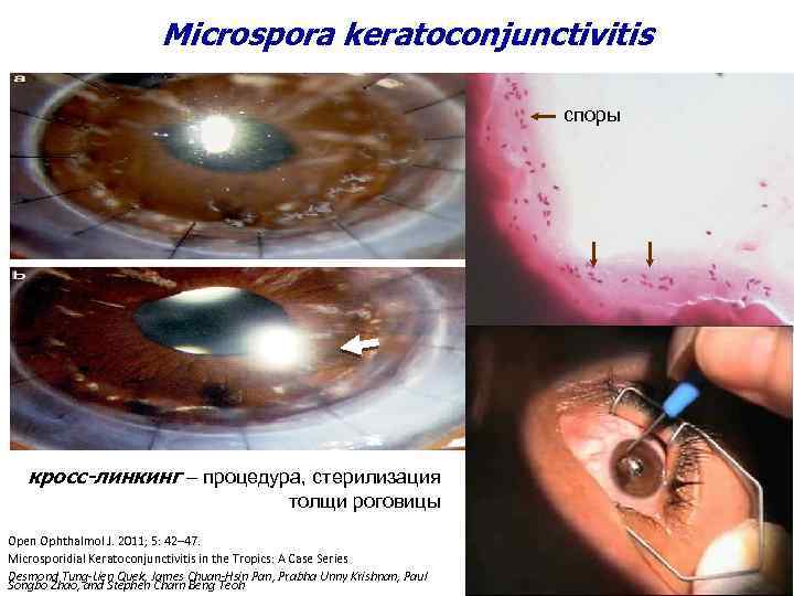 Microspora keratoconjunctivitis споры кросс-линкинг – процедура, стерилизация толщи роговицы Open Ophthalmol J. 2011; 5: