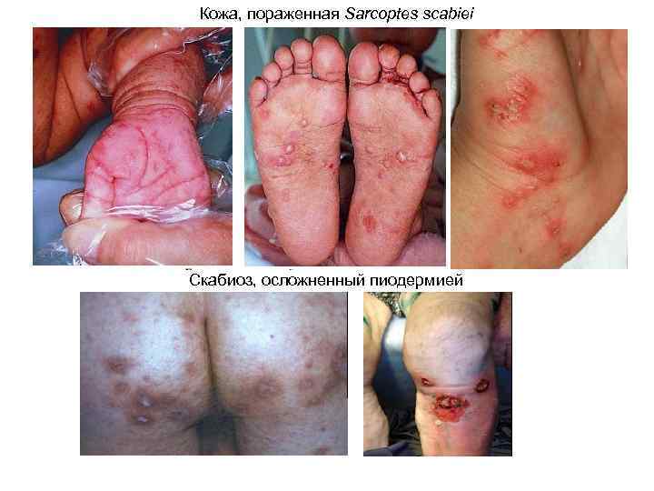 Кожа, пораженная Sarcoptes scabiei Скабиоз, осложненный пиодермией 