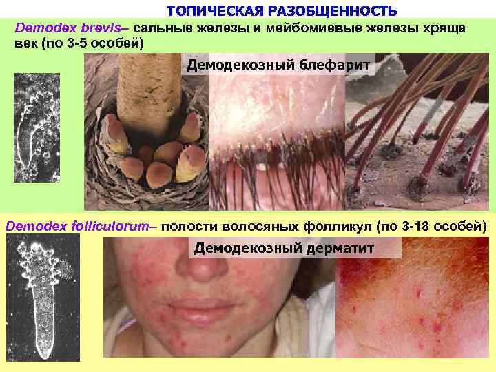 ТОПИЧЕСКАЯ РАЗОБЩЕННОСТЬ Demodex brevis– сальные железы и мейбомиевые железы хряща век (по 3 -5