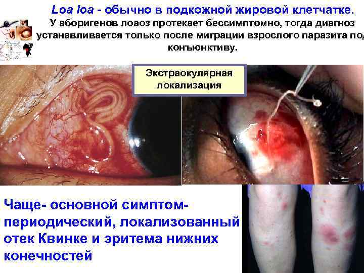 Loa loa - обычно в подкожной жировой клетчатке. У аборигенов лоаоз протекает бессимптомно, тогда