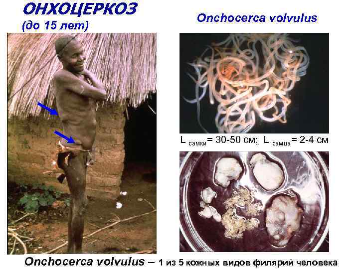 ОНХОЦЕРКОЗ (до 15 лет) Onchocerca volvulus L самки= 30 -50 см; L самца= 2