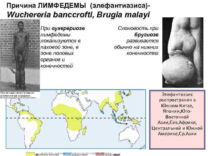 Причина ЛИМФЕДЕМЫ (элефантиазиса)- Wuchereria banccrofti, Brugia malayi При вухерериозе лимфедемы локализуются в паховой зоне,