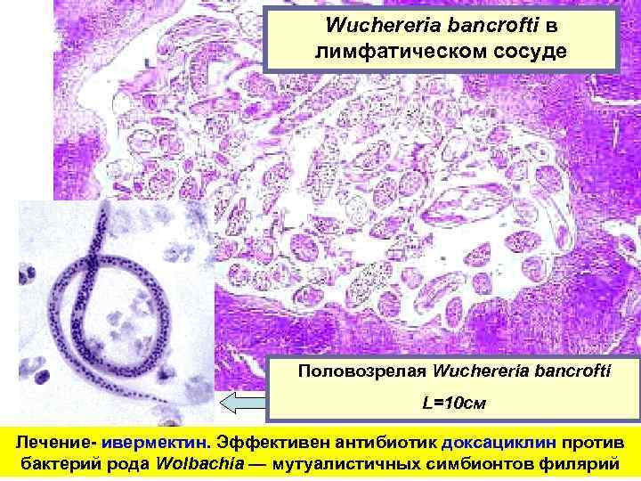 Wuchereria bancrofti в лимфатическом сосуде Половозрелая Wuchereria bancrofti L=10 см Лечение- ивермектин. Эффективен антибиотик