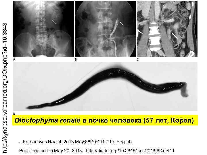 http: //synapse. koreamed. org/DOIx. php? id=10. 3348 Dioctophyma renale в почке человека (57 лет,