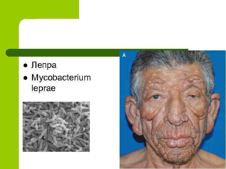 l l Лепра Mycobacterium leprae 