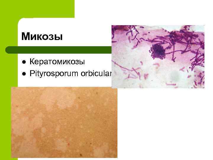 Микозы l l Кератомикозы Рityrosporum orbicularis 