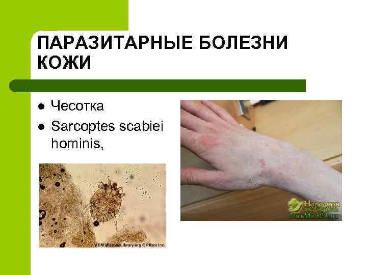 ПАРАЗИТАРНЫЕ БОЛЕЗНИ КОЖИ l l Чесотка Sarcoptes scabiei hominis, 