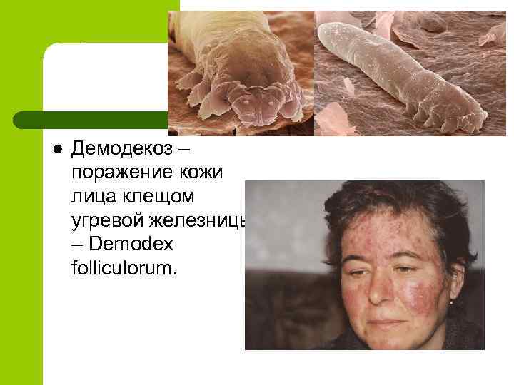 l Демодекоз – поражение кожи лица клещом угревой железницы – Demodex folliculorum. 