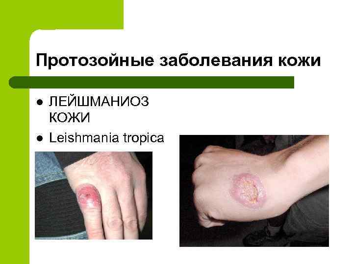 Протозойные заболевания кожи l l ЛЕЙШМАНИОЗ КОЖИ Leishmania tropica 