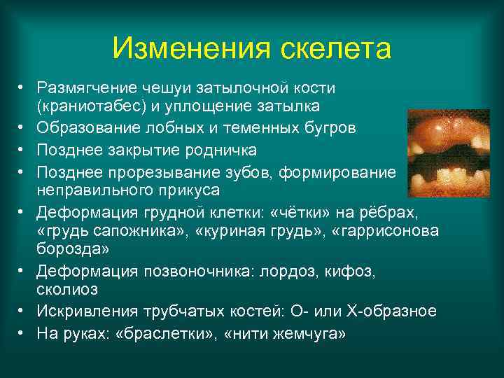 Изменения скелета • Размягчение чешуи затылочной кости (краниотабес) и уплощение затылка • Образование лобных