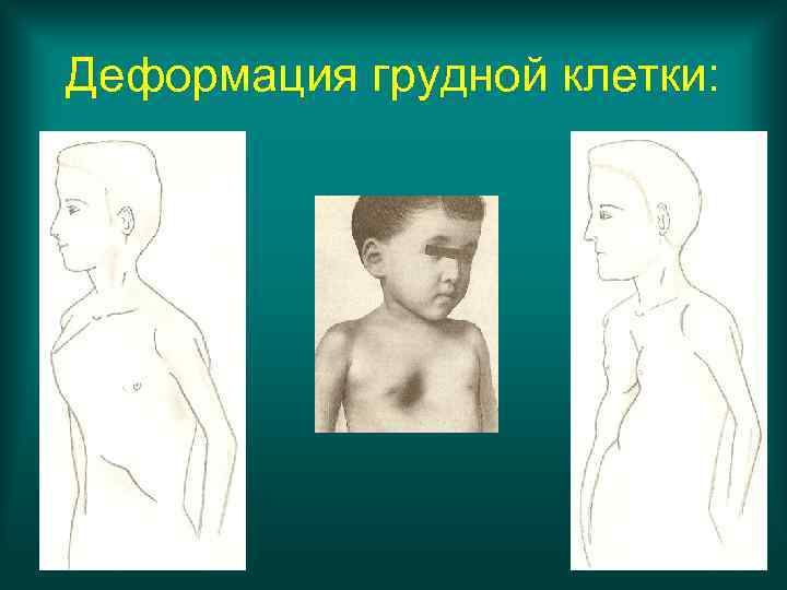 Деформация грудной клетки: 