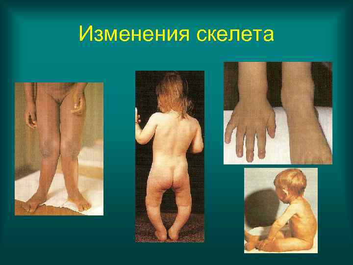 Изменения скелета 