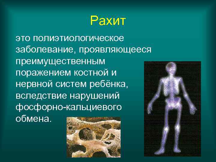 Рахит это полиэтиологическое заболевание, проявляющееся преимущественным поражением костной и нервной систем ребёнка, вследствие нарушений