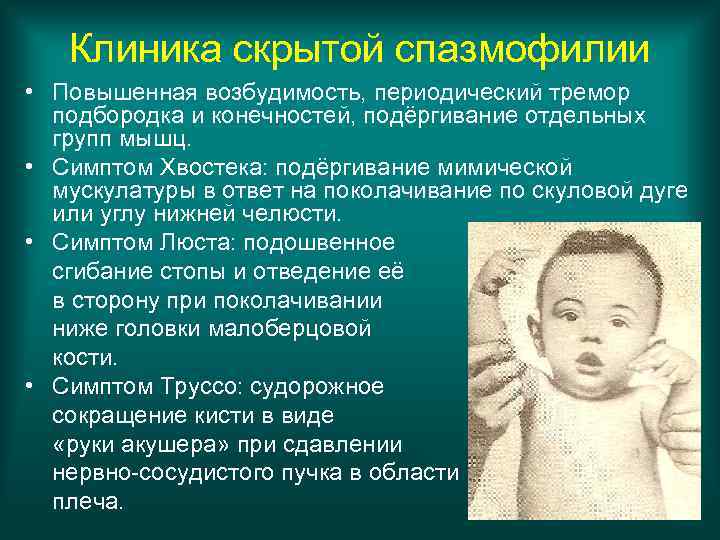 Клиника скрытой спазмофилии • Повышенная возбудимость, периодический тремор подбородка и конечностей, подёргивание отдельных групп