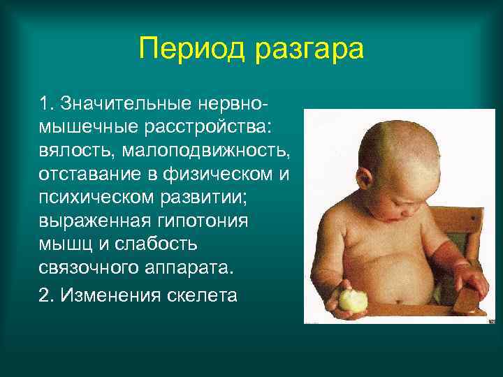 Период разгара 1. Значительные нервномышечные расстройства: вялость, малоподвижность, отставание в физическом и психическом развитии;