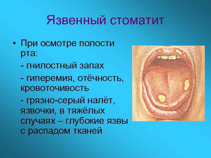 Язвенный стоматит • При осмотре полости рта: - гнилостный запах - гиперемия, отёчность, кровоточивость