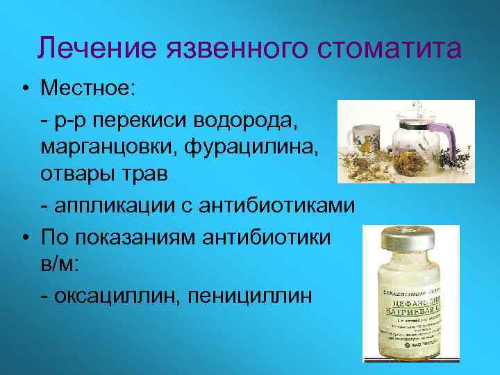 Лечение язвенного стоматита • Местное: - р-р перекиси водорода, марганцовки, фурацилина, отвары трав -