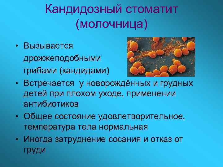 Кандидозный стоматит (молочница) • Вызывается дрожжеподобными грибами (кандидами) • Встречается у новорождённых и грудных