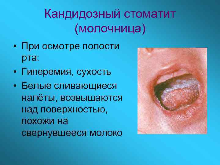 Кандидозный стоматит (молочница) • При осмотре полости рта: • Гиперемия, сухость • Белые сливающиеся