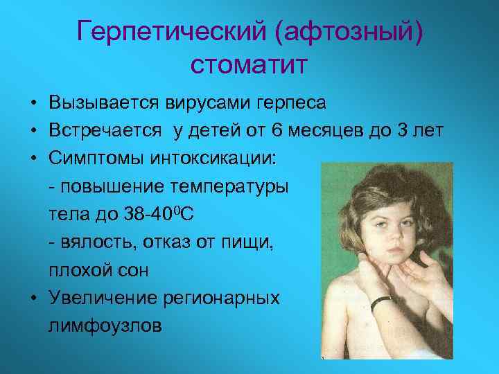 Герпетический (афтозный) стоматит • Вызывается вирусами герпеса • Встречается у детей от 6 месяцев