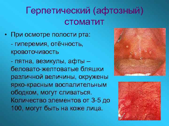 Герпетический (афтозный) стоматит • При осмотре полости рта: - гиперемия, отёчность, кровоточивость - пятна,
