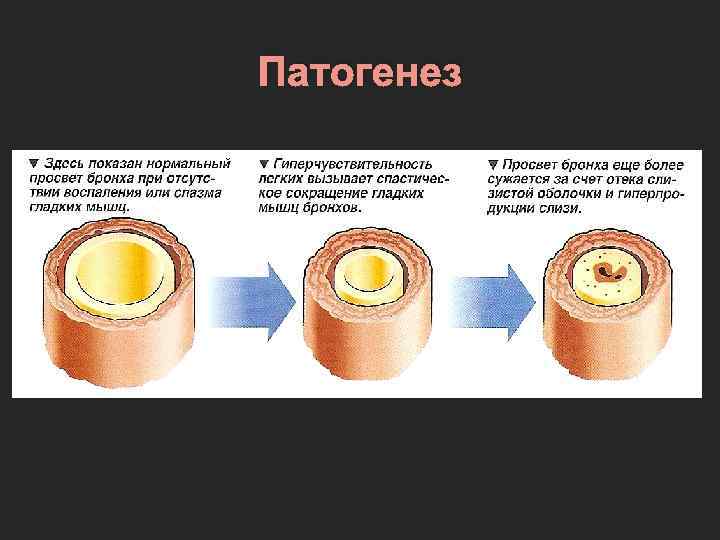 Патогенез 