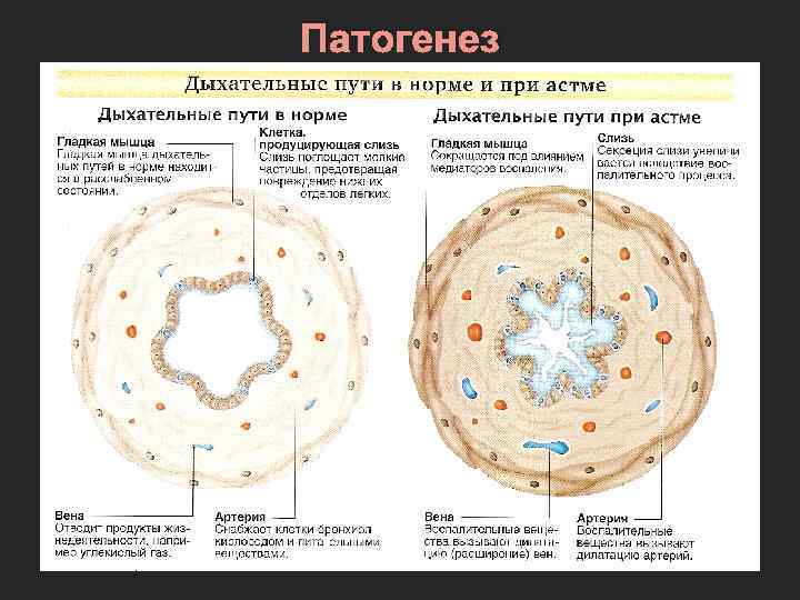 Патогенез 