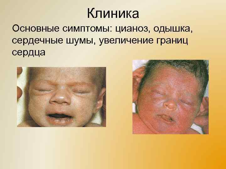 Клиника Основные симптомы: цианоз, одышка, сердечные шумы, увеличение границ сердца 