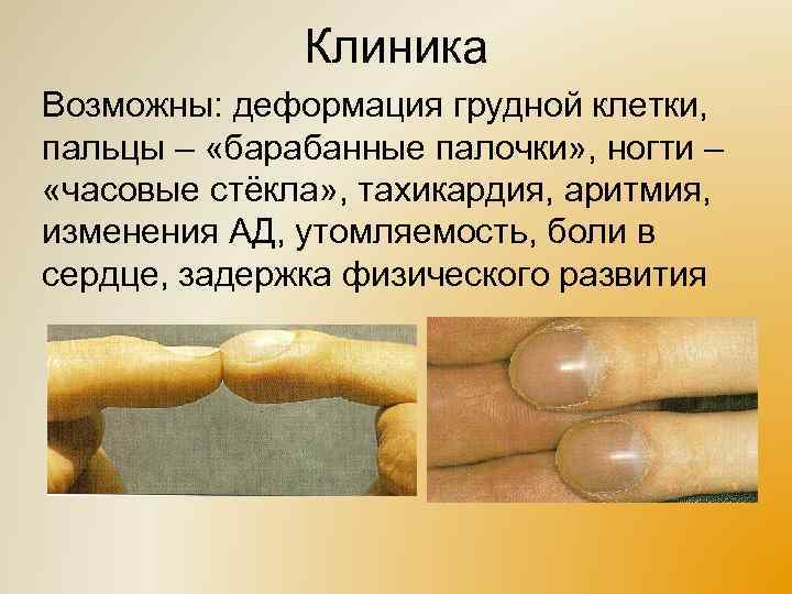 Клиника Возможны: деформация грудной клетки, пальцы – «барабанные палочки» , ногти – «часовые стёкла»