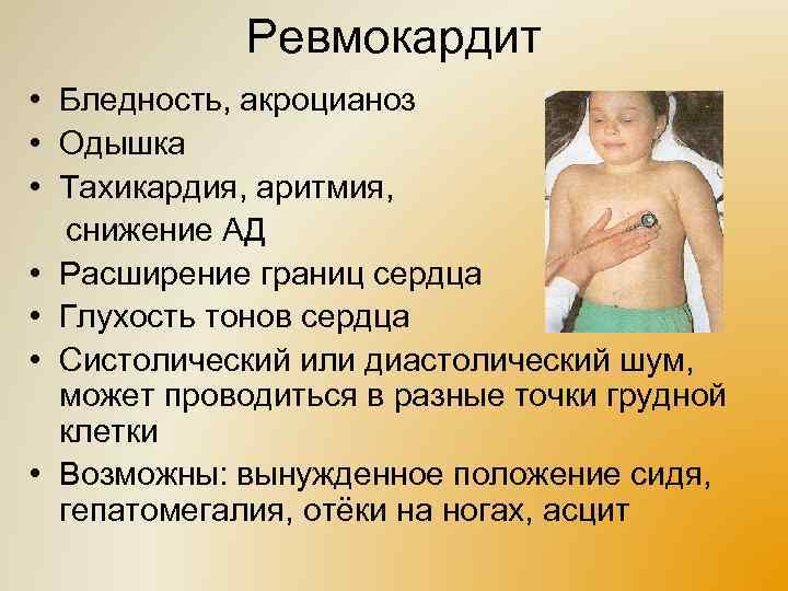 Ревмокардит • Бледность, акроцианоз • Одышка • Тахикардия, аритмия, снижение АД • Расширение границ