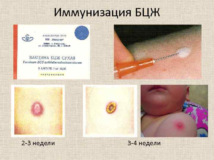 Иммунизация БЦЖ 2 -3 недели 3 -4 недели 