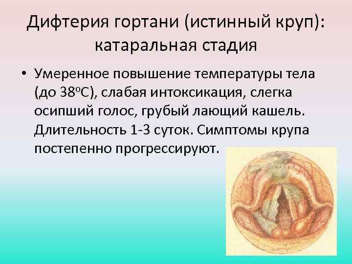 Дифтерия гортани (истинный круп): катаральная стадия • Умеренное повышение температуры тела (до 38 о.