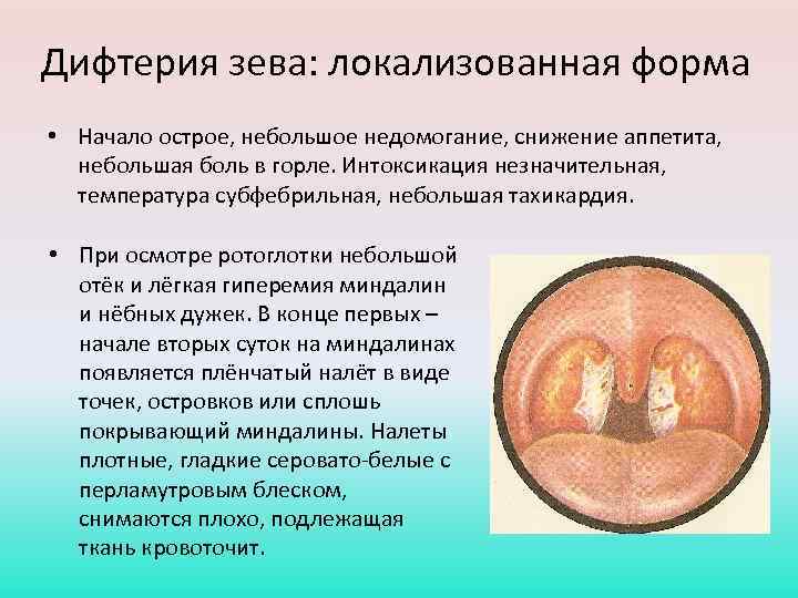 Дифтерия зева: локализованная форма • Начало острое, небольшое недомогание, снижение аппетита, небольшая боль в