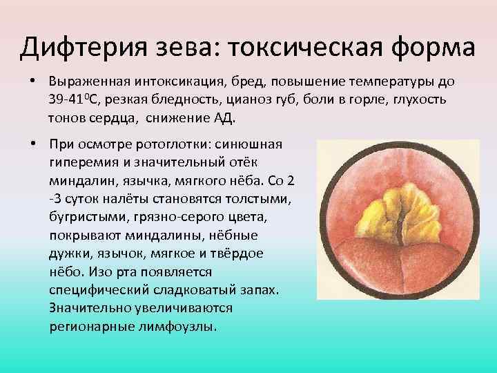 Дифтерия зева: токсическая форма • Выраженная интоксикация, бред, повышение температуры до 39 -410 С,