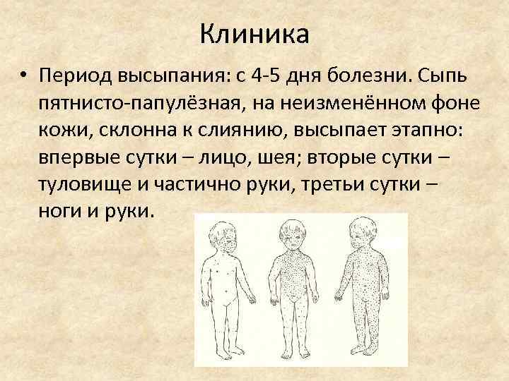 Клиника • Период высыпания: с 4 -5 дня болезни. Сыпь пятнисто-папулёзная, на неизменённом фоне